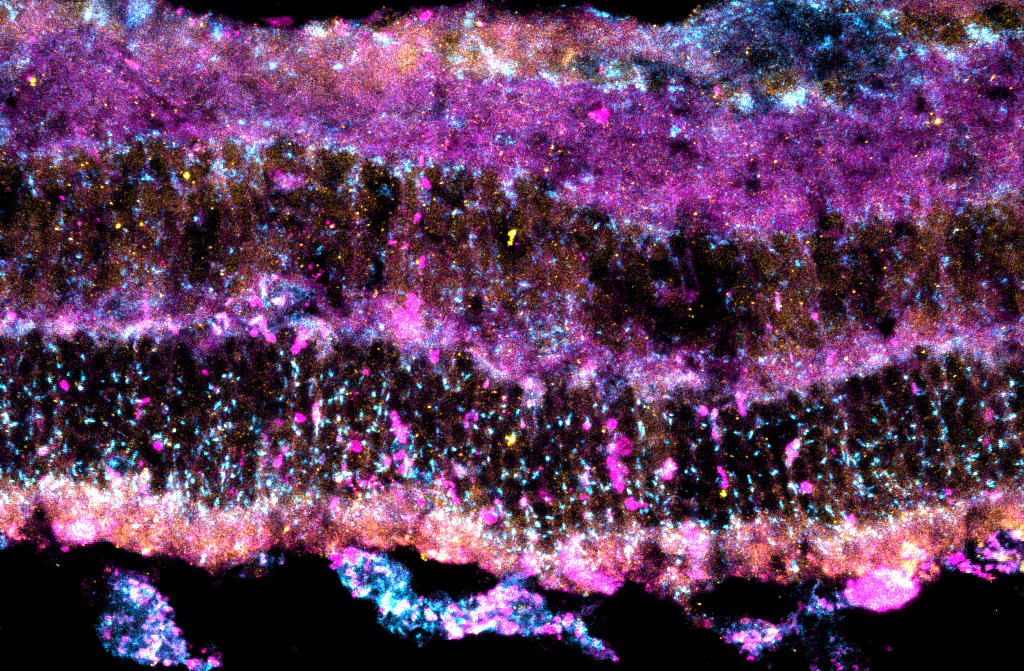 Immunohistochemistry of AMD model mouse retina. Protein aggregates (magenta), lysosomes (cyan), and autophagosomes (yellow) can be observed.