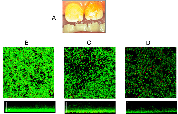 Figure 1. Macroscopic (A) and microscopic (B, C, and D) views of a bacterial biofilm. Unkempt teeth develop bacterial biofilms that can be visible, and that can lead to diseases, rotting, and falling of the teeth. Under a fluorescence microscope and using a commercial staining procedure, live bacteria are stained in green, whereas dead ones are stained in red. B shows a healthy biofilm; C, depicts an older biofilm, whereas D shows a decaying biofilm. Panel A was taken from J. Portilla Robertson et al. (2010) Rev Odont Mex, 14, 218-225. Panels B, C. and D were taken from Chan et al (2018) Toxins 10, 378.